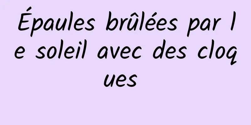 Épaules brûlées par le soleil avec des cloques 