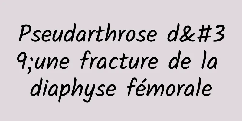 Pseudarthrose d'une fracture de la diaphyse fémorale