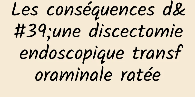 Les conséquences d'une discectomie endoscopique transforaminale ratée