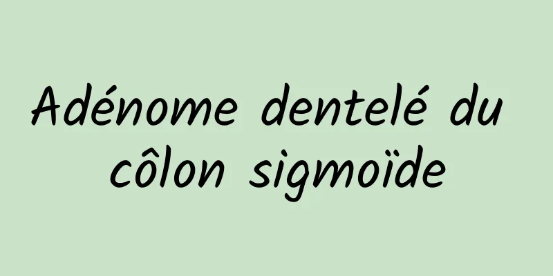 Adénome dentelé du côlon sigmoïde