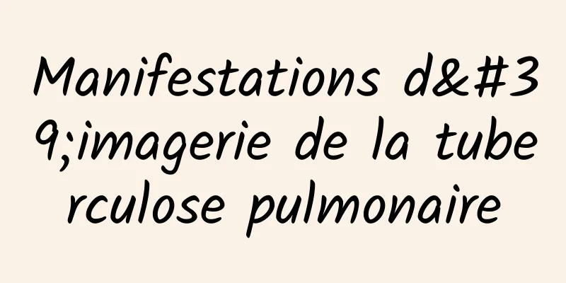 Manifestations d'imagerie de la tuberculose pulmonaire