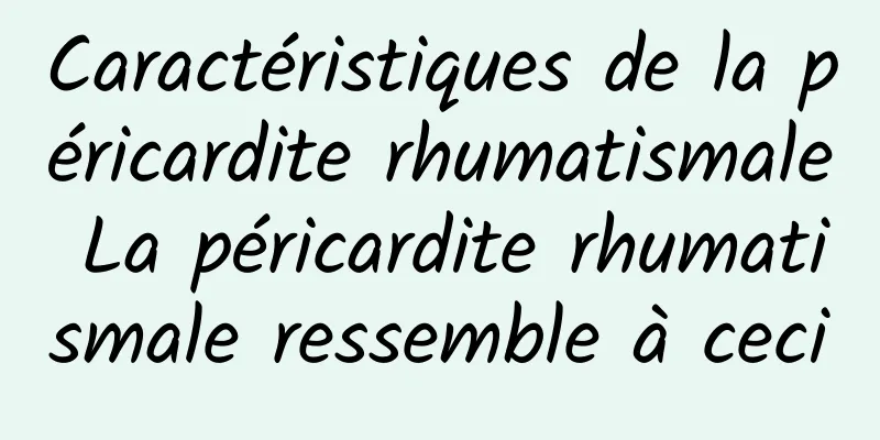 Caractéristiques de la péricardite rhumatismale La péricardite rhumatismale ressemble à ceci